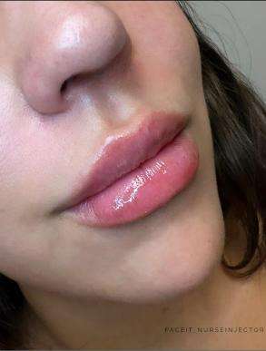 danielleaesthetics-lip-fillers-botox-halifax