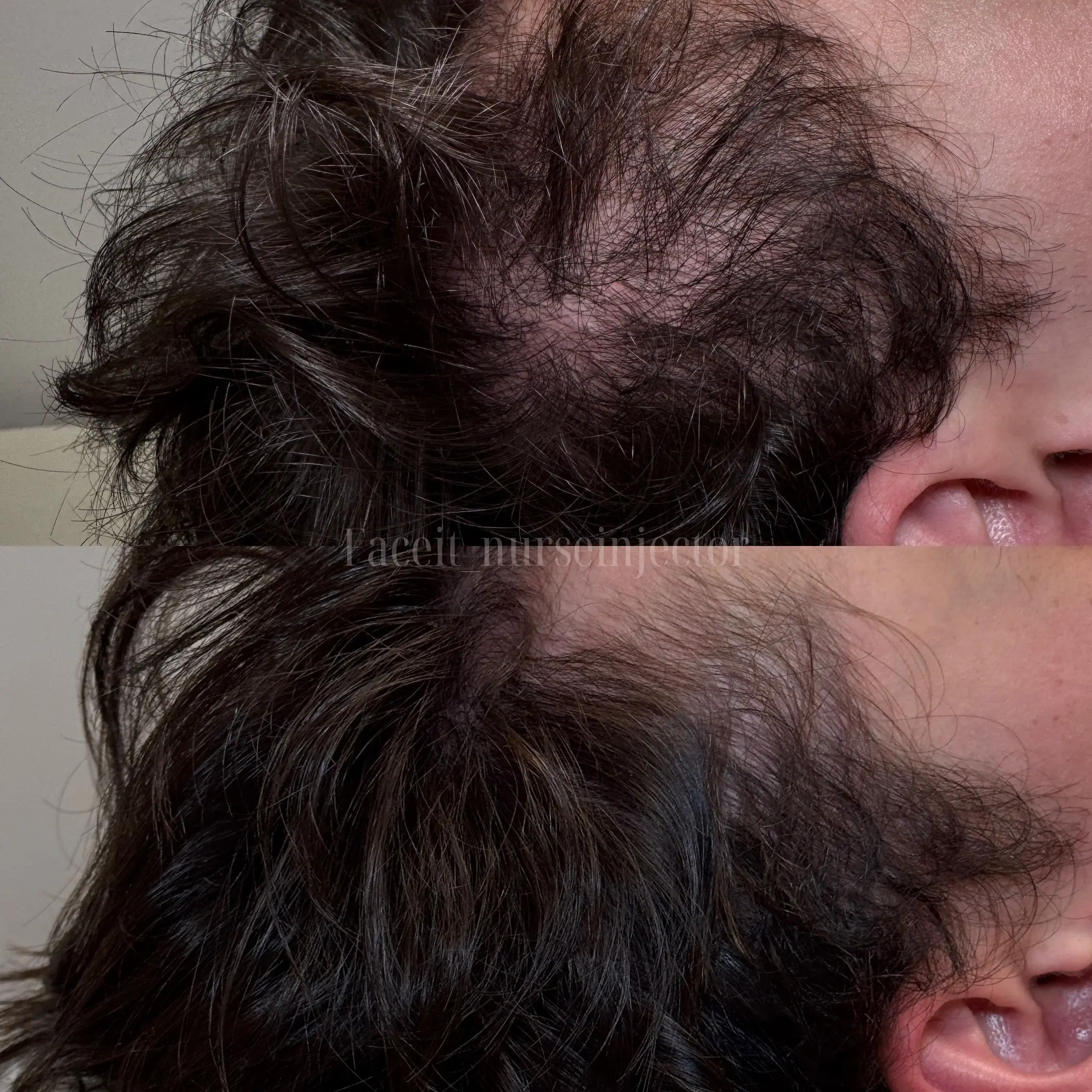 Hair PRP